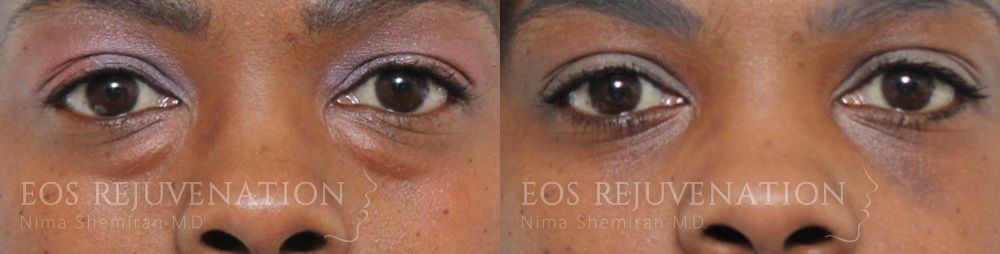 Lower Blepharoplasty Before & After