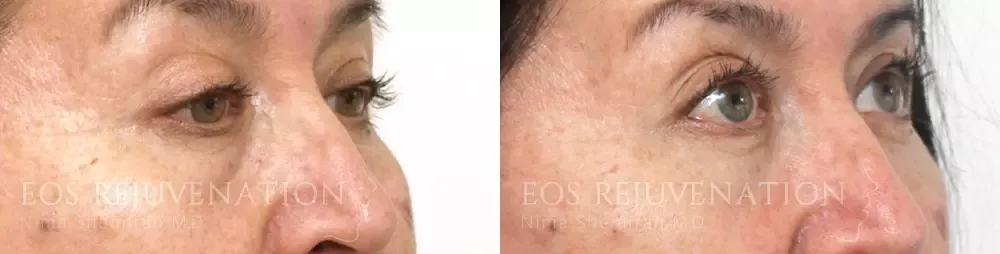 Lower Blepharoplasty Before & After