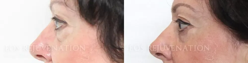 Lower Blepharoplasty Before & After