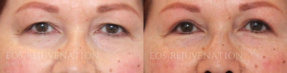 Lower Blepharoplasty Before & After