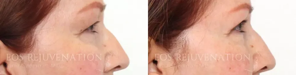 Lower Blepharoplasty Before & After