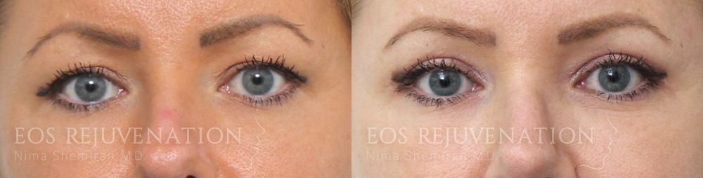 Upper Blepharoplasty Before & After