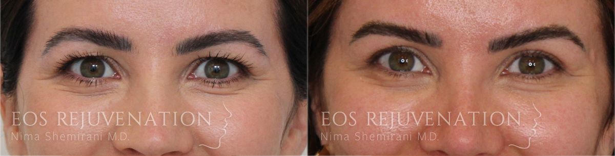 Upper Blepharoplasty Before & After