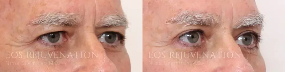 Upper Blepharoplasty Before & After