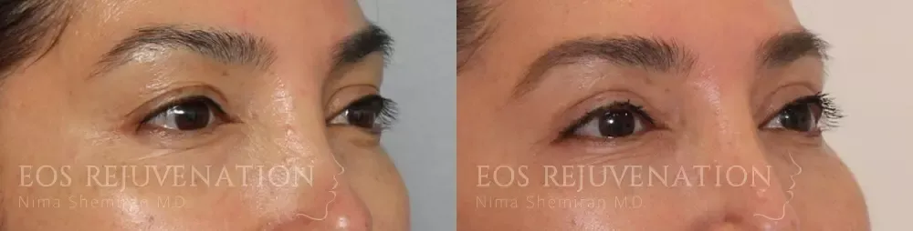 Upper Blepharoplasty Before & After