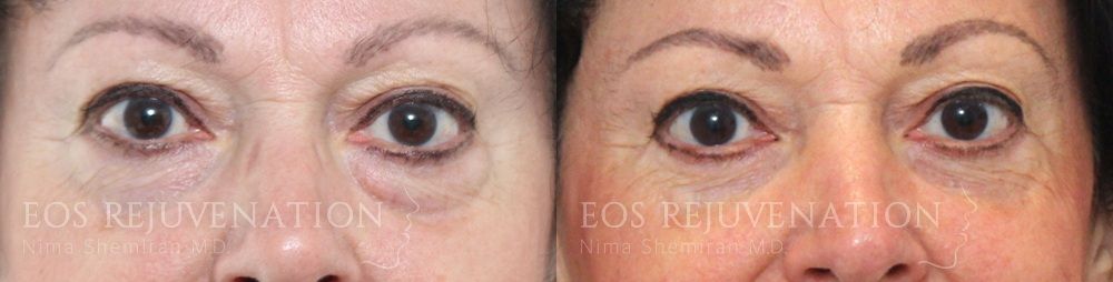 Upper Blepharoplasty Before & After