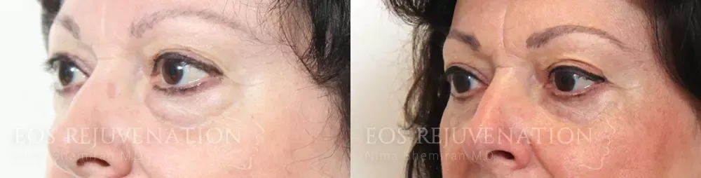 Upper Blepharoplasty Before & After