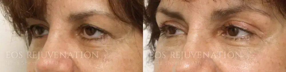 Upper Blepharoplasty Before & After