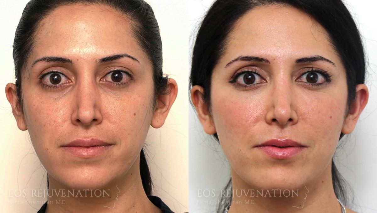 Fat Transfer Before & After