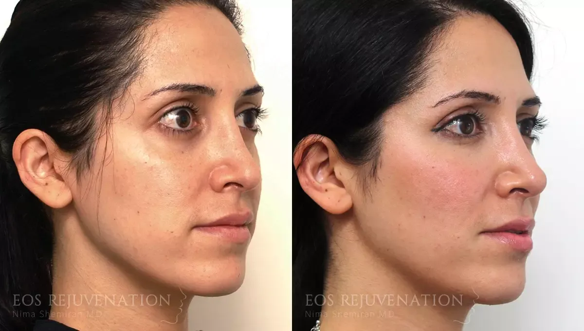 Fat Transfer Before & After