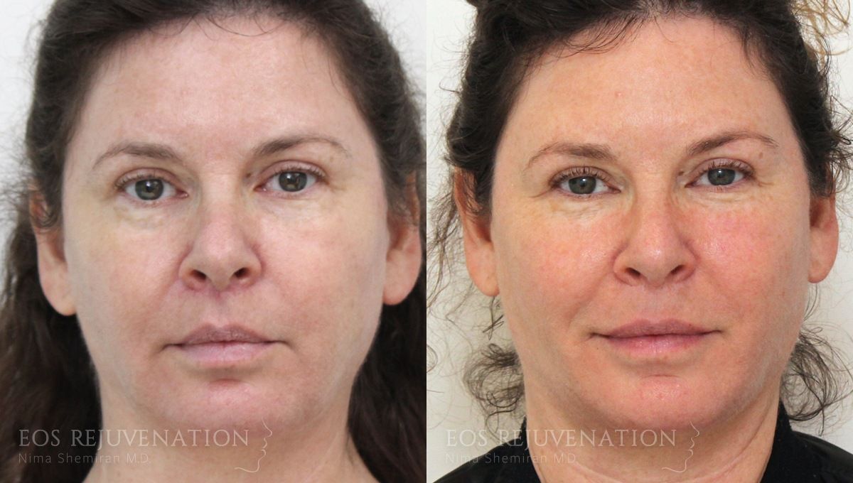 Fat Transfer Before & After