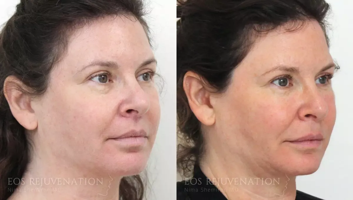 Fat Transfer Before & After