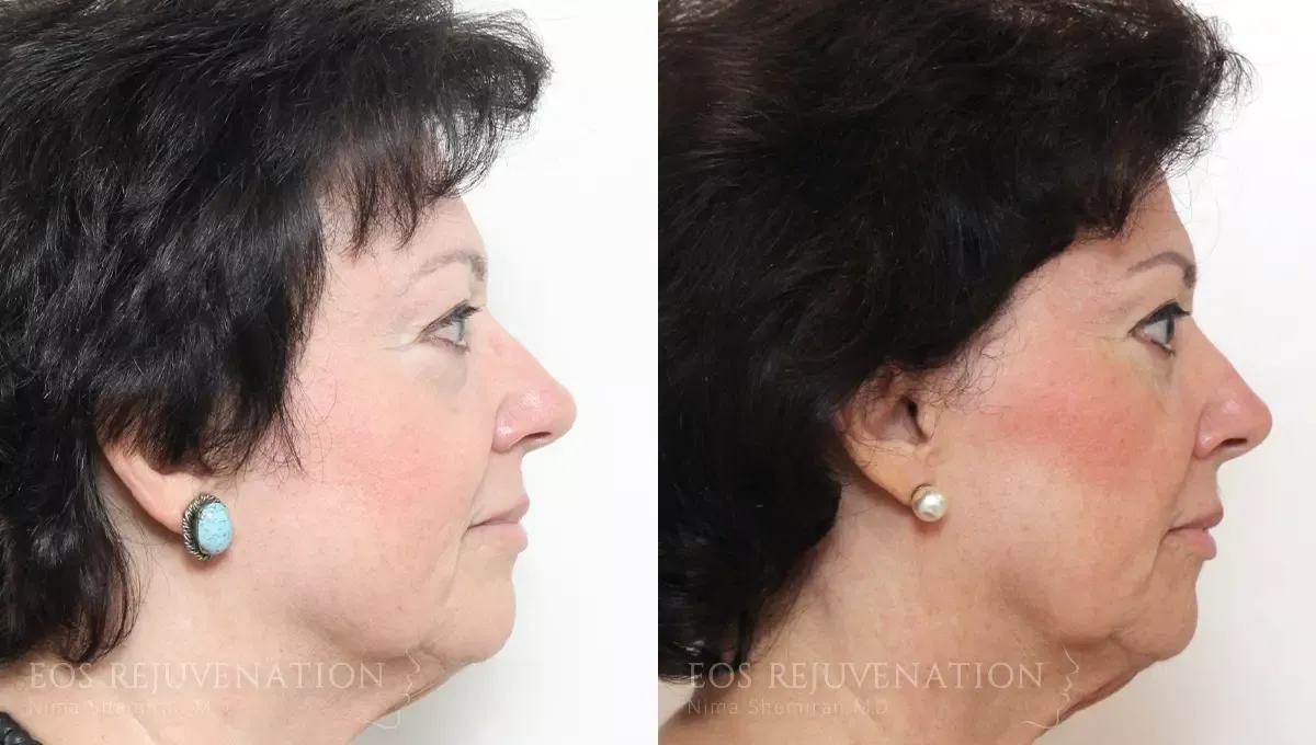 Fat Transfer Before & After