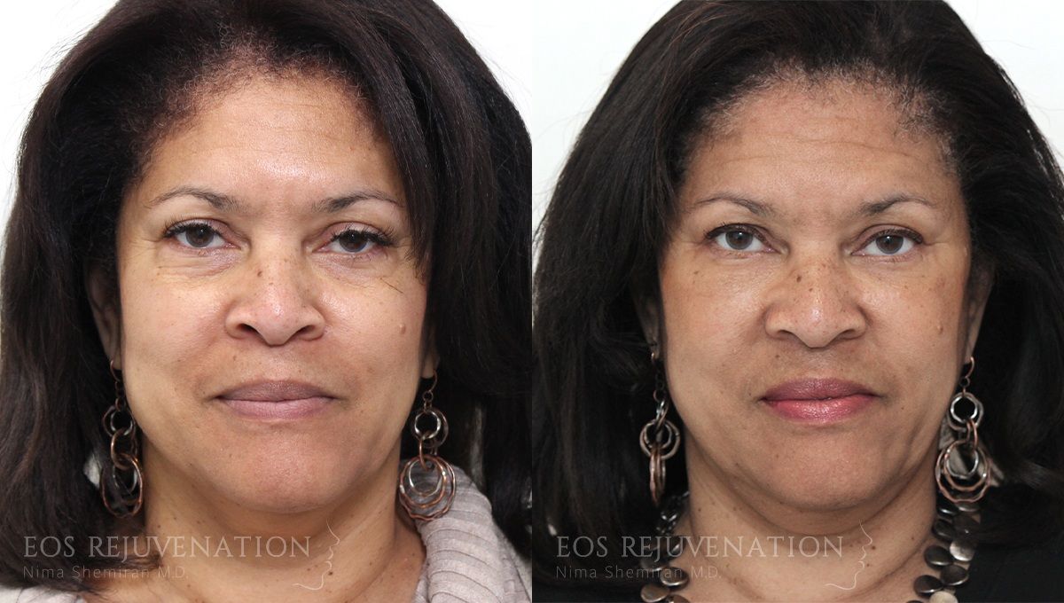 Fat Transfer Before & After