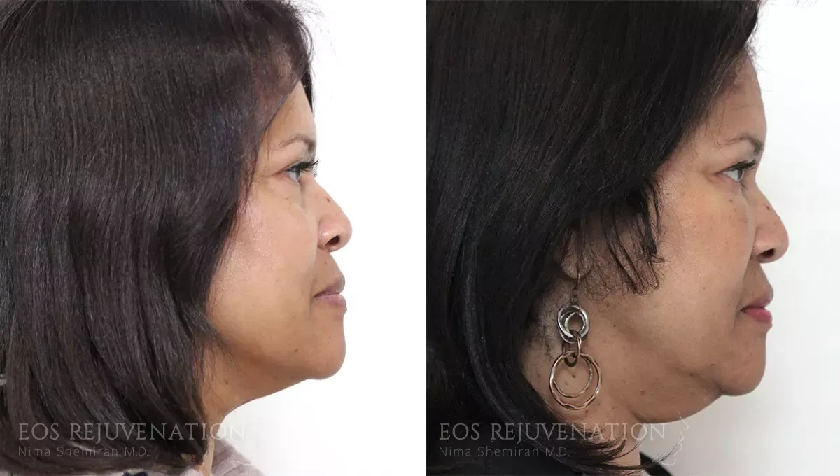 Fat Transfer Before & After