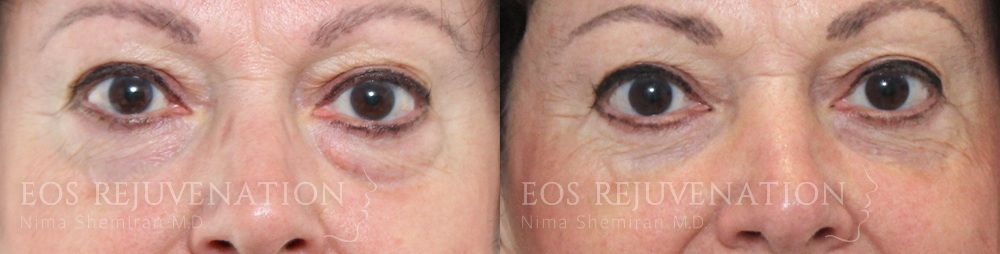 Blepharoplasty Before & After