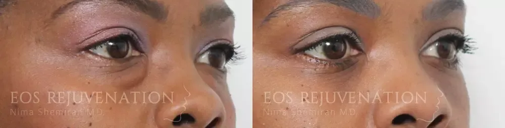 Blepharoplasty Before & After