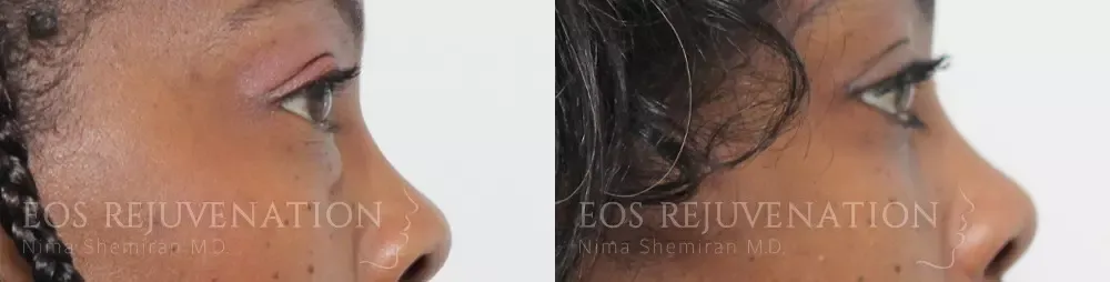 Blepharoplasty Before & After