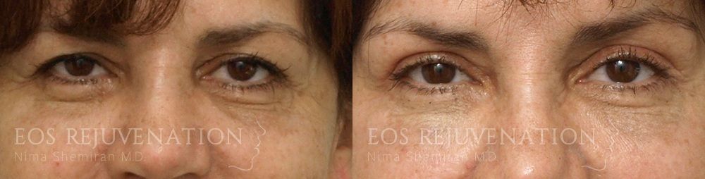 Blepharoplasty Before & After