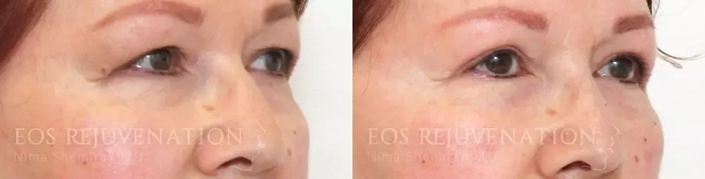 Blepharoplasty Before & After