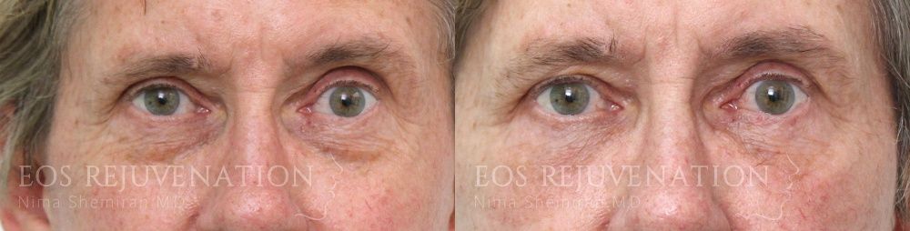 Blepharoplasty Before & After