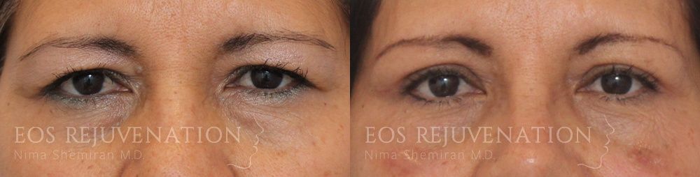 Blepharoplasty Before & After