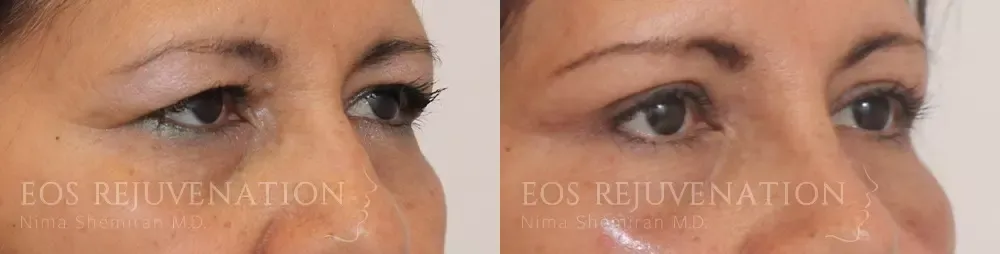 Blepharoplasty Before & After