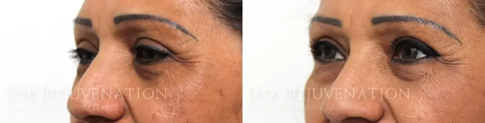 Blepharoplasty Before & After