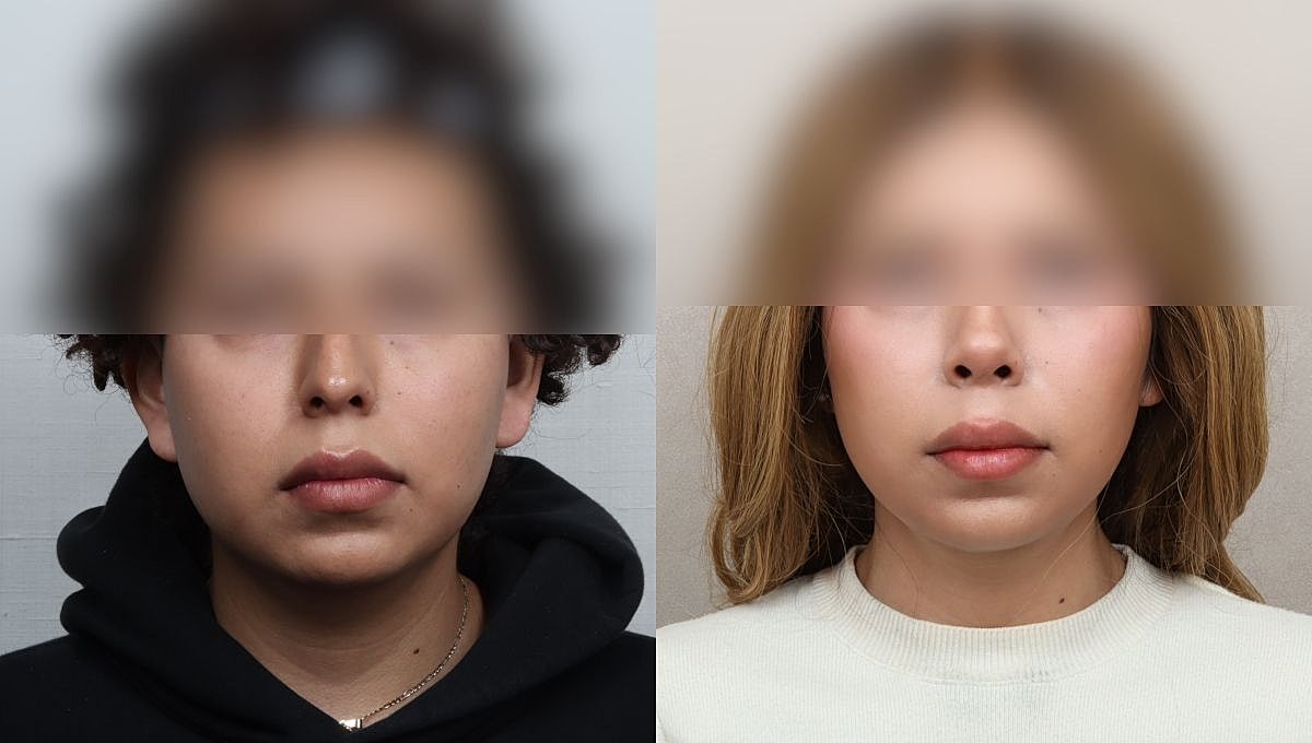 Facial Feminization Rhinoplasty Before & After