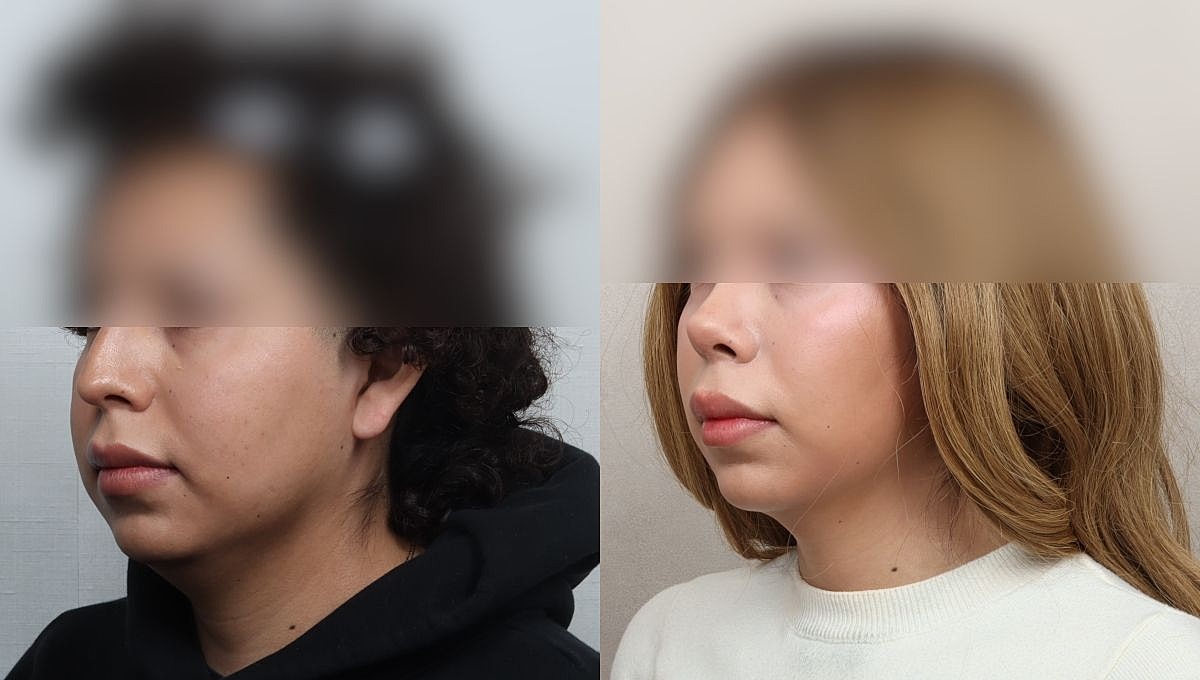 Facial Feminization Rhinoplasty Before & After