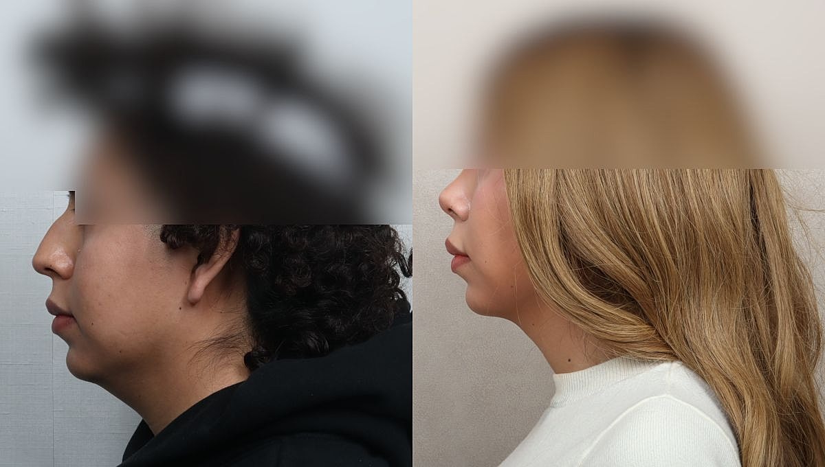 Facial Feminization Rhinoplasty Before & After