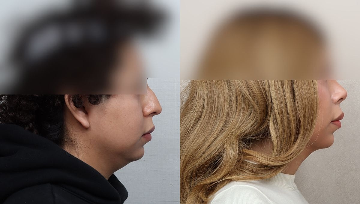 Facial Feminization Rhinoplasty Before & After