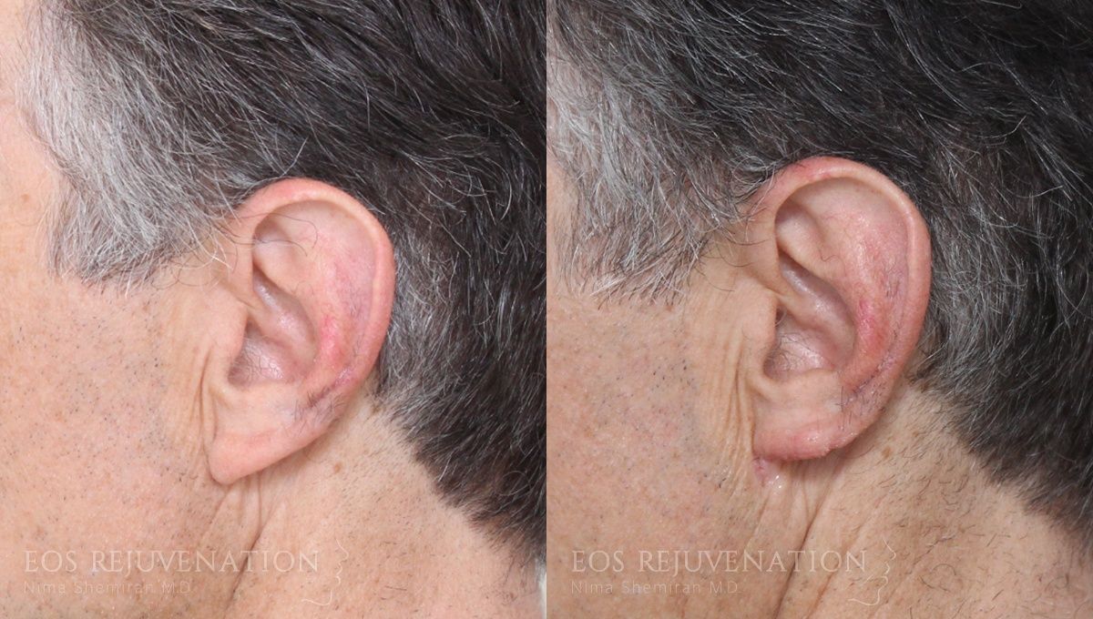 Earlobe Reduction Before & After