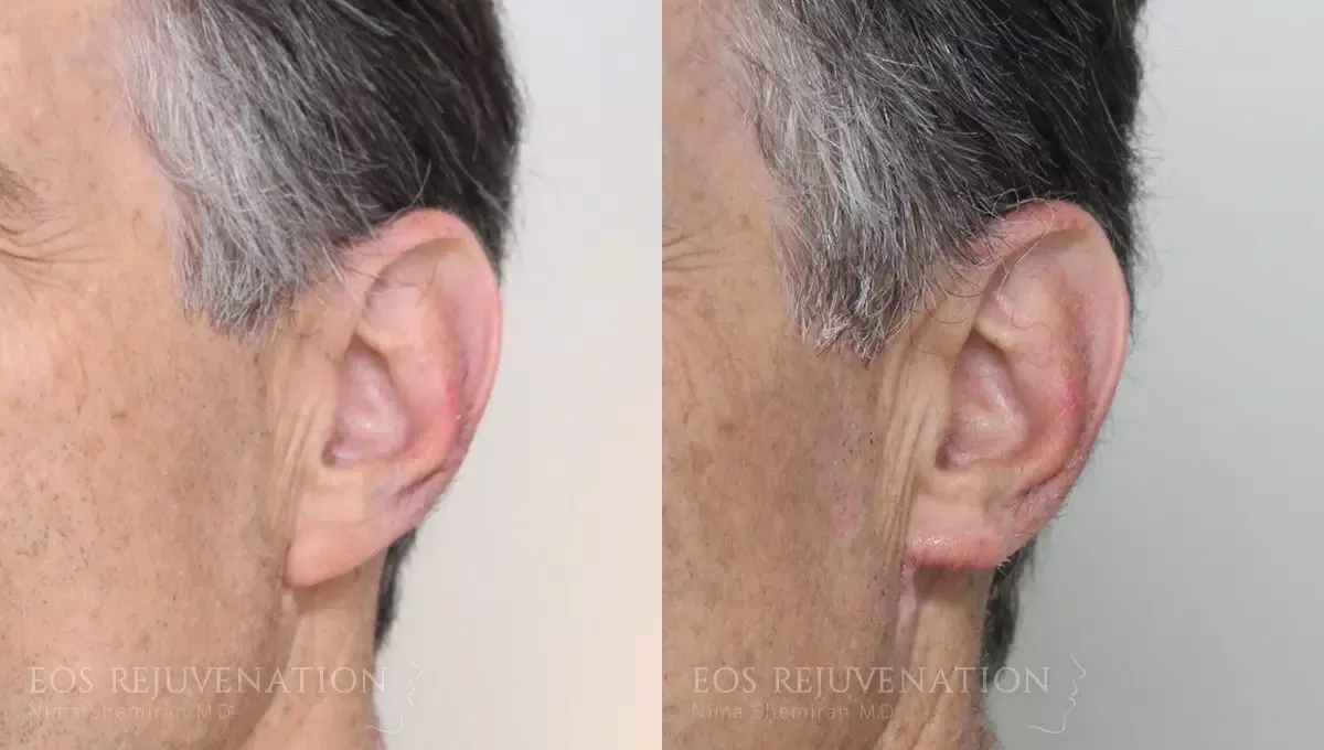 Earlobe Reduction Before & After