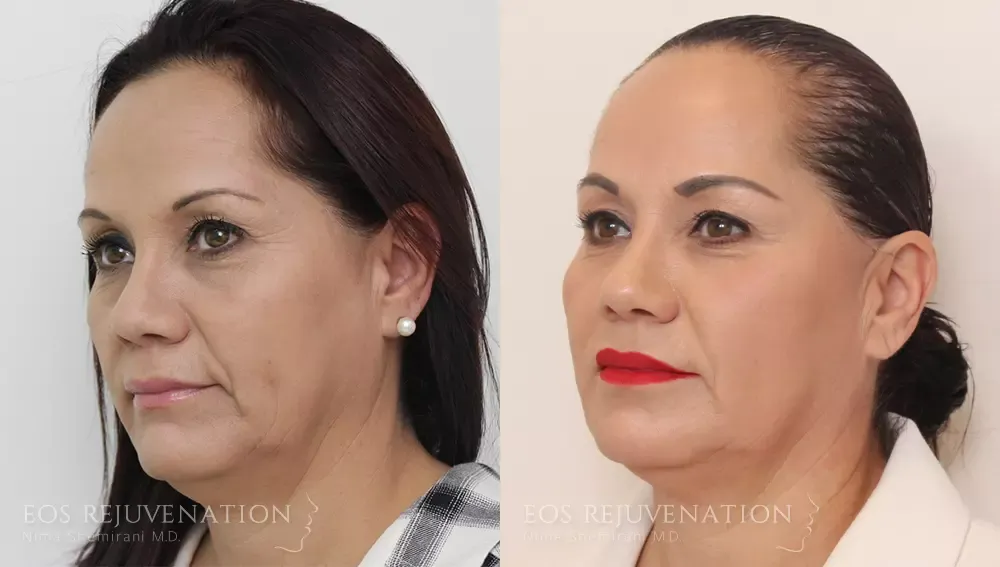 Liquid Facelift Before & After