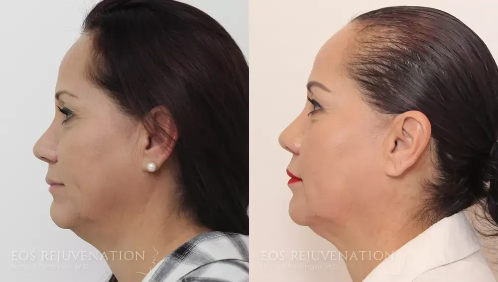 Liquid Facelift Before & After