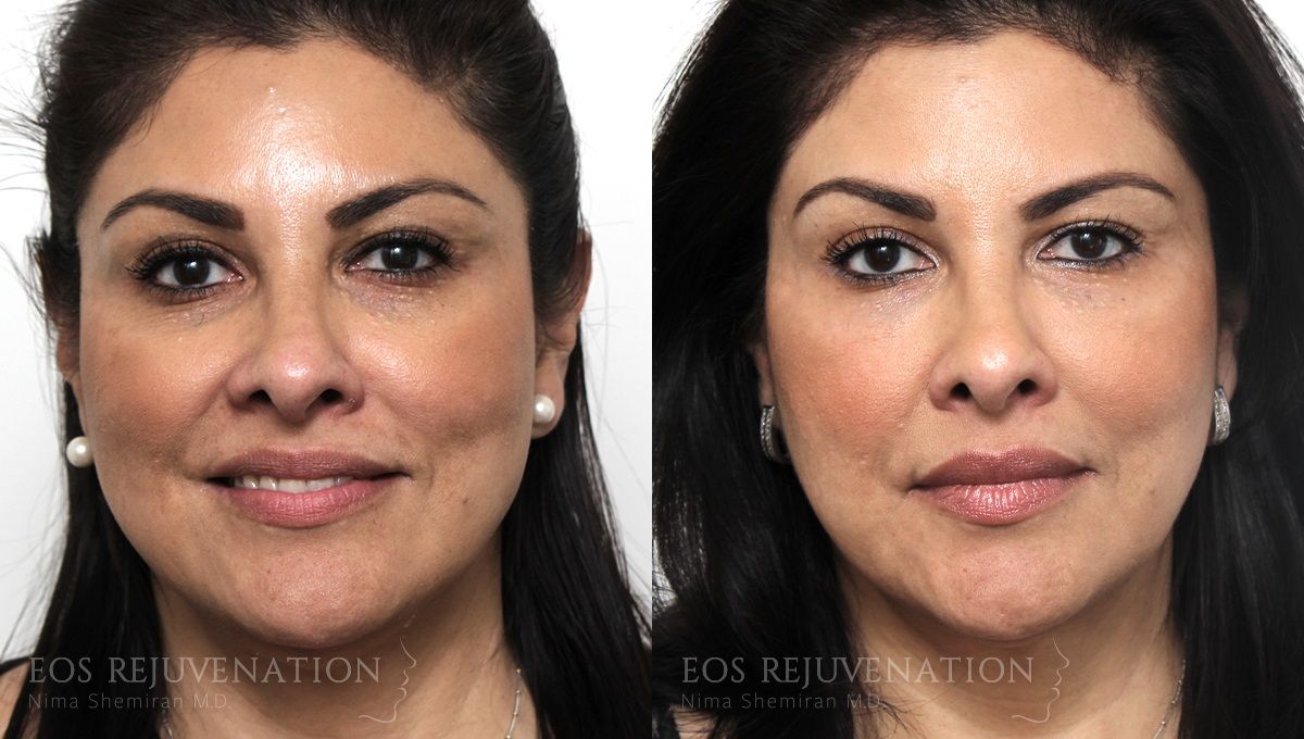Cheek Augmentation Before & After