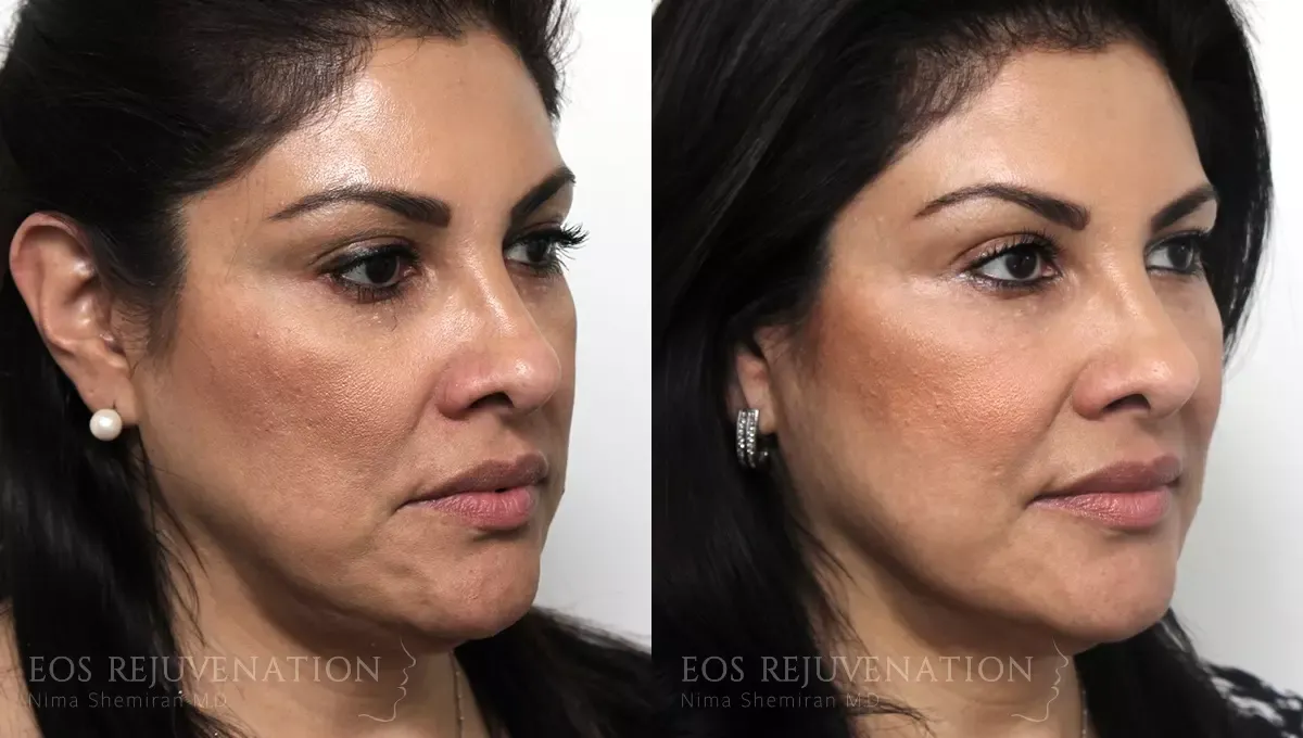 Cheek Augmentation Before & After