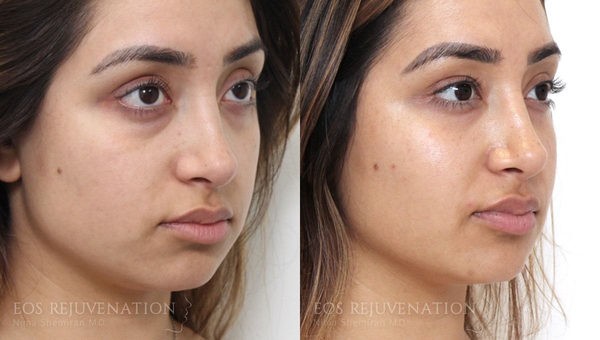 Cheek Augmentation Before & After