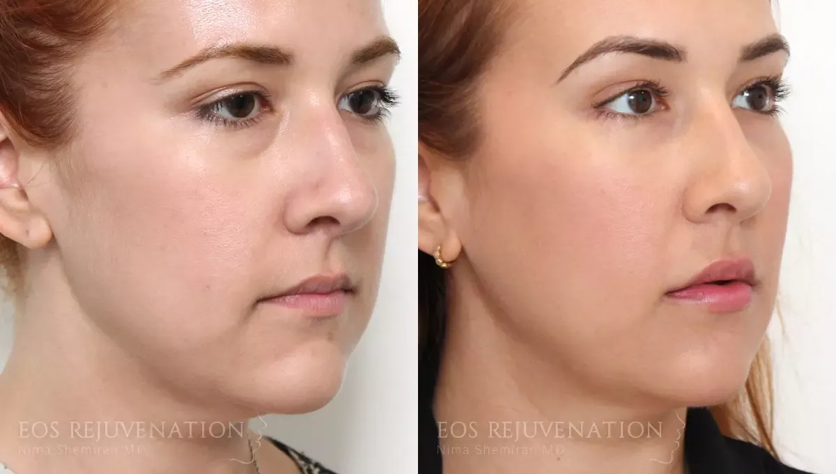 Cheek Augmentation Before & After