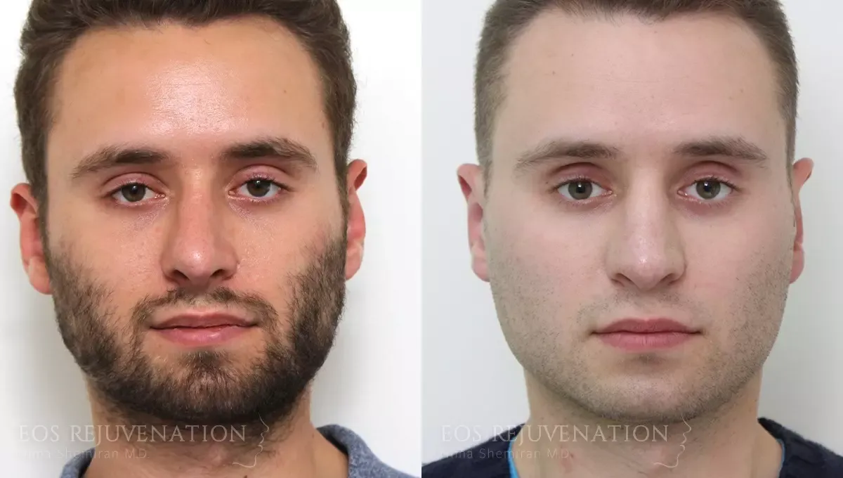 Otoplasty Before & After