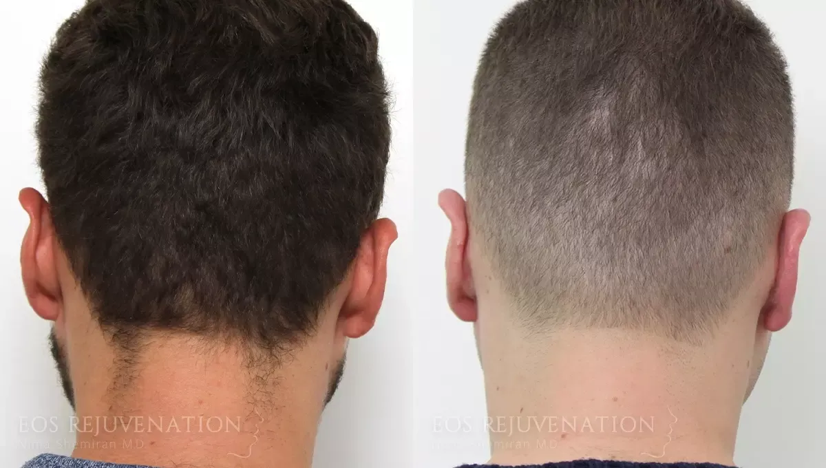 Otoplasty Before & After