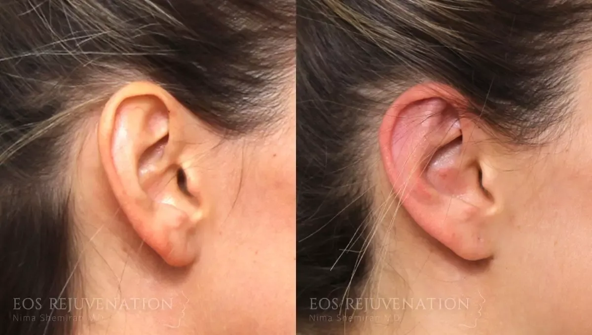 Otoplasty Before & After