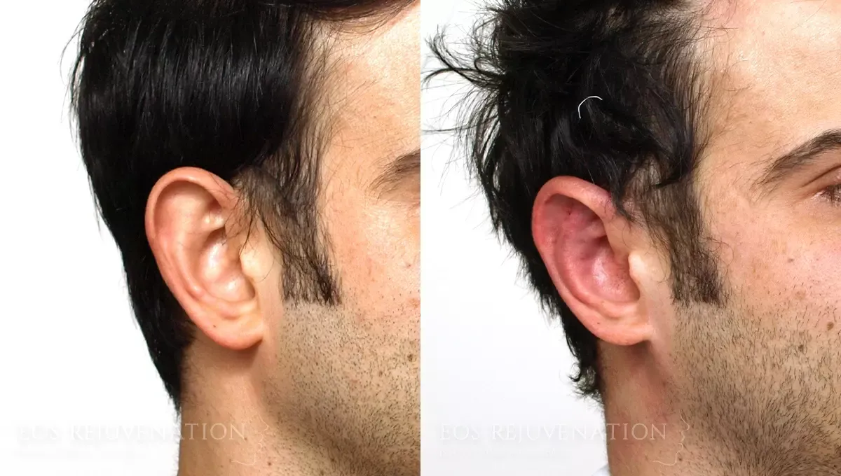 Otoplasty Before & After