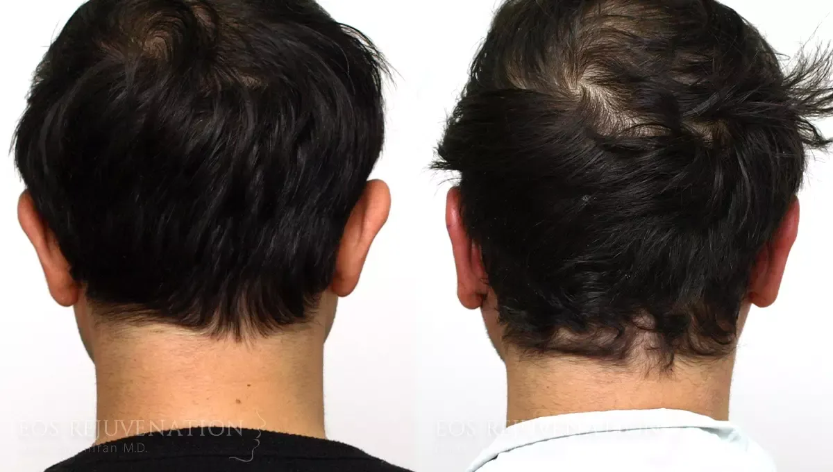 Otoplasty Before & After