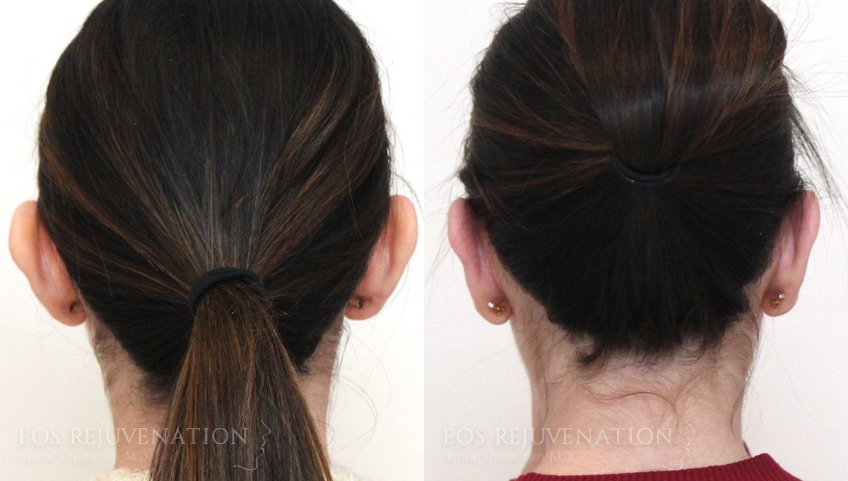 Otoplasty Before & After