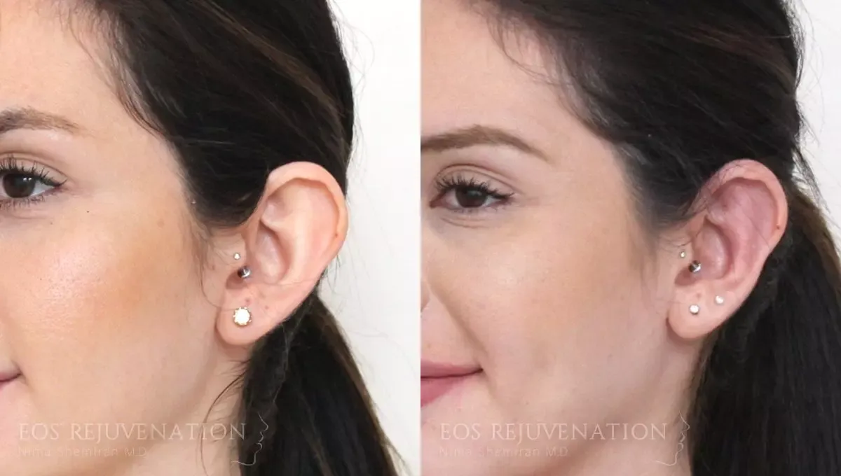 Otoplasty Before & After