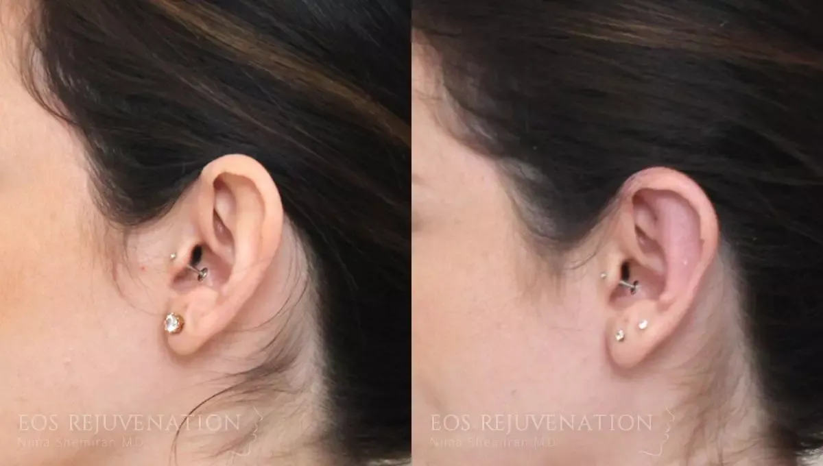 Otoplasty Before & After