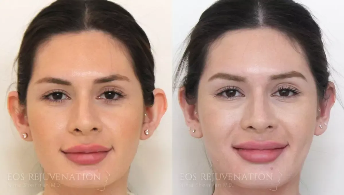 Otoplasty Before & After