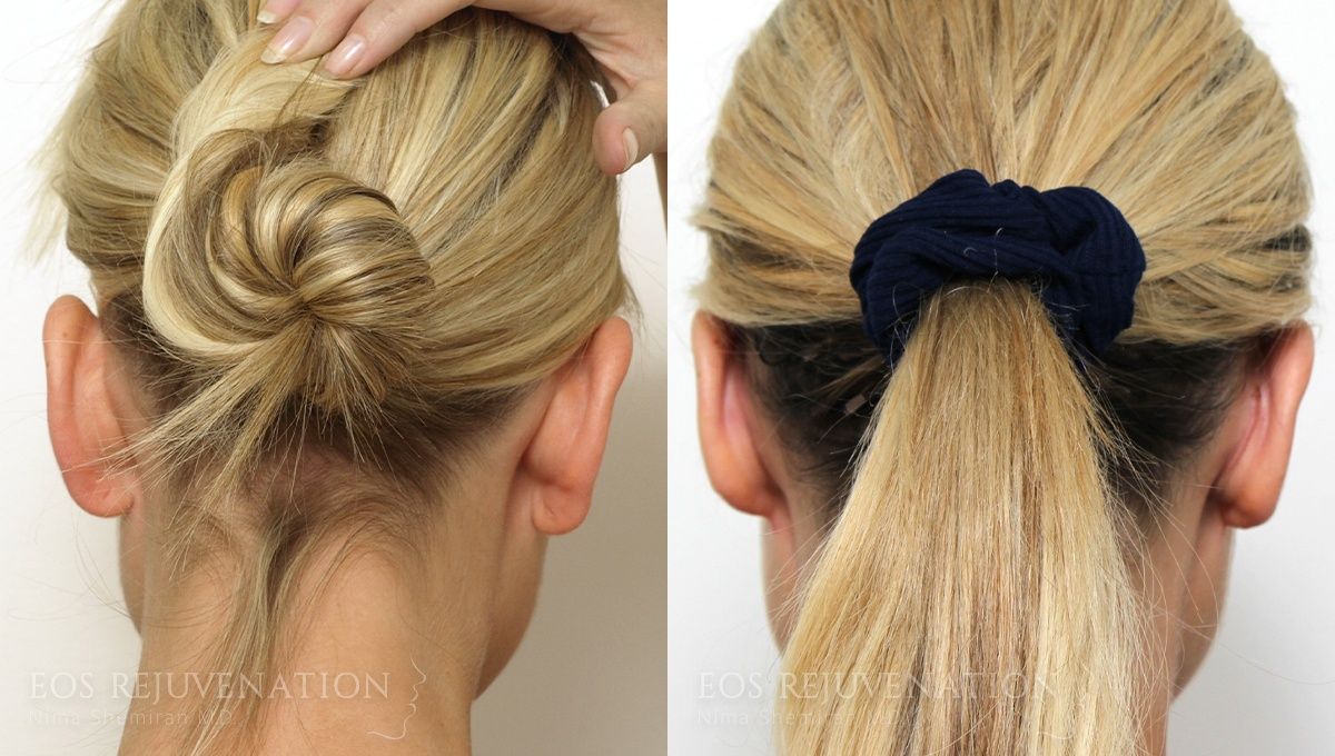 Otoplasty Before & After